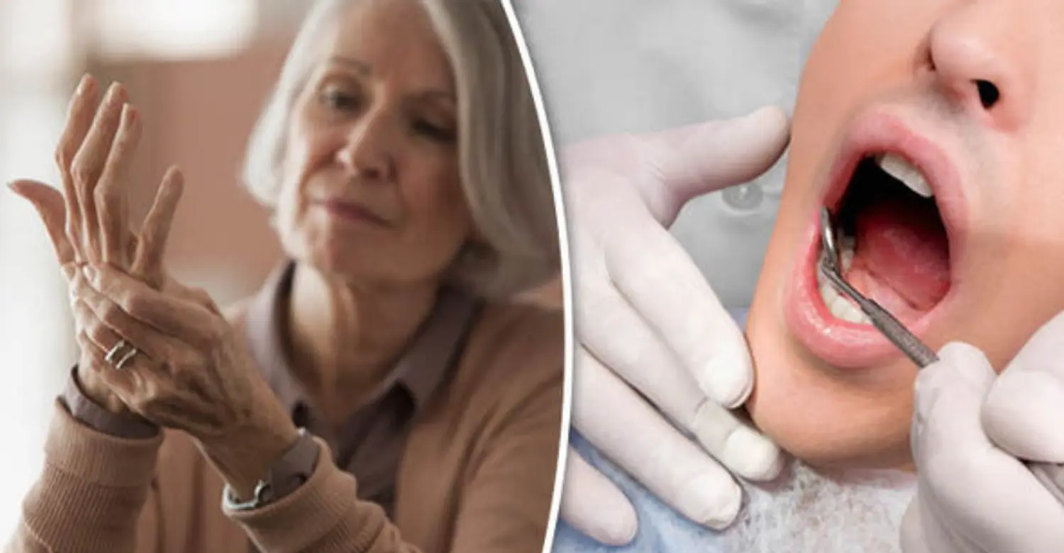 Rheumatoid Arthritis and Gum Disease 2